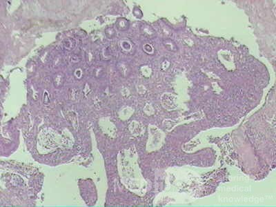 Case on Multiple Adenomas (large polyps) of the Rectum (34 of 37)