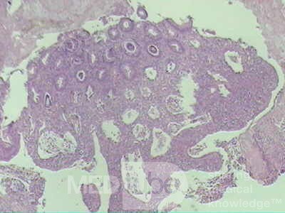 Case on Multiple Adenomas (large polyps) of the Rectum (34 of 37)