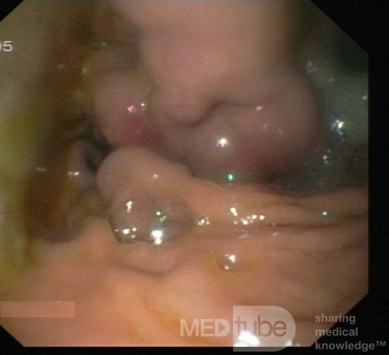 Gastric Fundal Varices