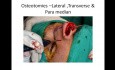 Hump Reduction Technique for beginners in Rhinoplasty - Step by Step 