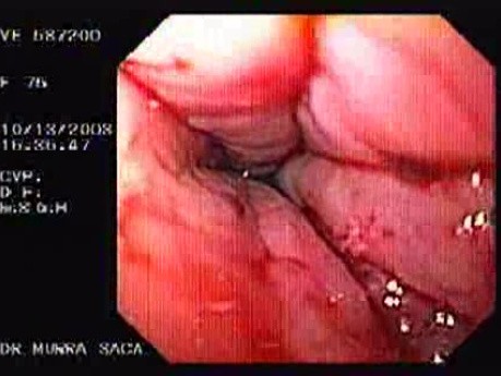 Successful Dilatation of Achalasia - Final Stage
