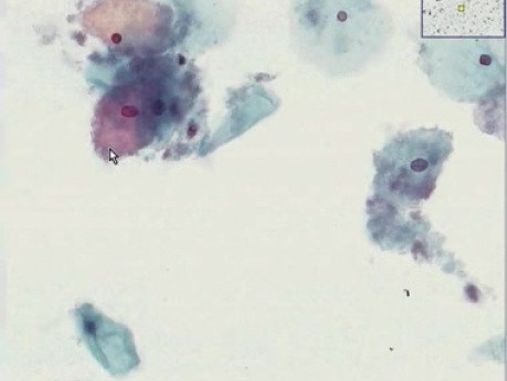 Bacterial vaginosis