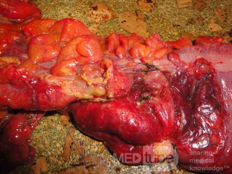 Multiple Rectal Ulcers (79 of 110)