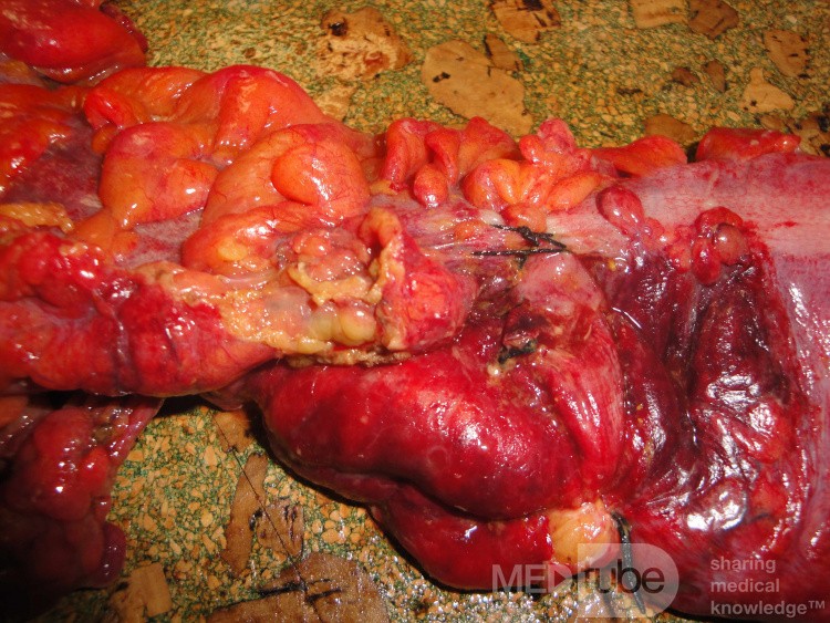 Multiple Rectal Ulcers (79 of 110)