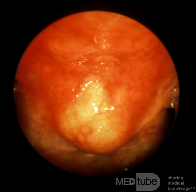 Tornwaldt's Cyst