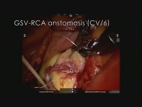 Arteriotomy of RCA