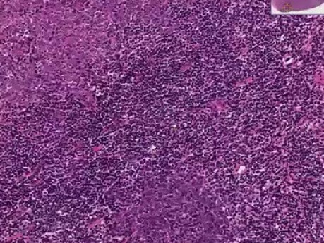 Metastatic undifferentiated large cell carcinoma
