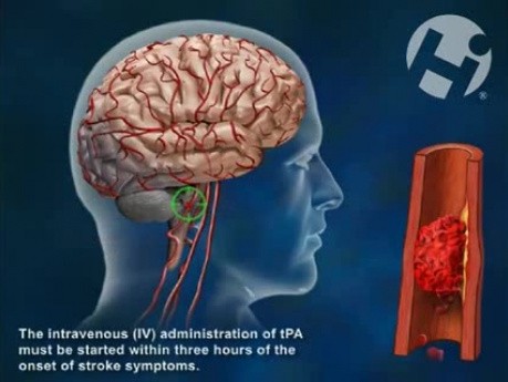 Tissue Plasminogen Activator (TPA)