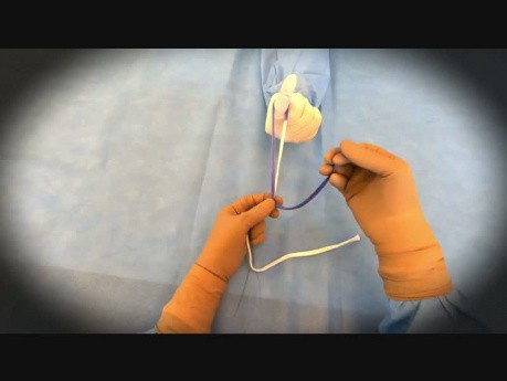 Laparoscopic Meltzer's Knot