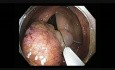 Colonoscopy Channel Quiz 20