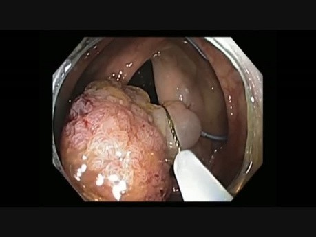 Colonoscopy Channel Quiz 20