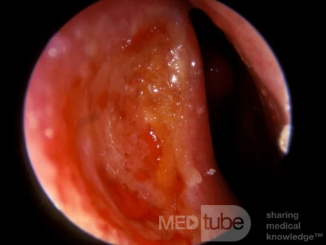 Nasal Septal Ulceration