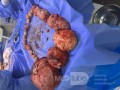 Huge Leiomyoma Uteri
