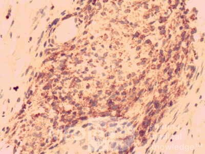 Gastrointestinal Stromal tumor (GIST) (64 of 65)