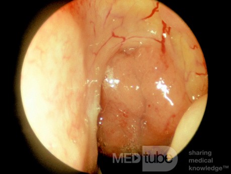 Moderately Enlarged Adenoids