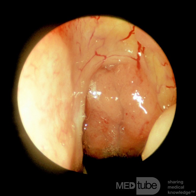 Moderately Enlarged Adenoids
