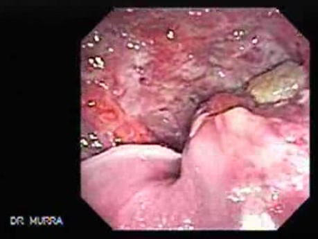 Adenocarcinoma of the Cardia and Carcinoma Epidermoid of the Larynx (8 of 26)