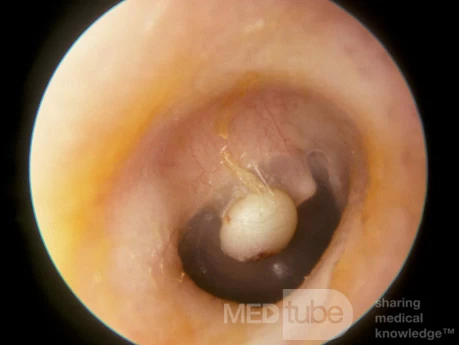 Epidermal Cyst Tympanic Membrane.