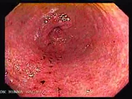 Erosions On The Gastric Mucosa - Gastroscopy