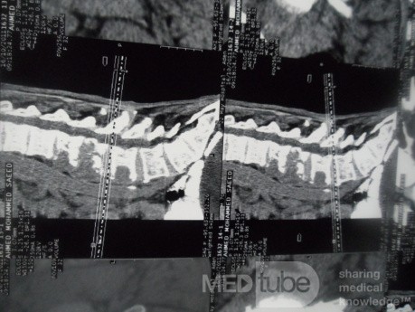 Pancreas cancer - 9