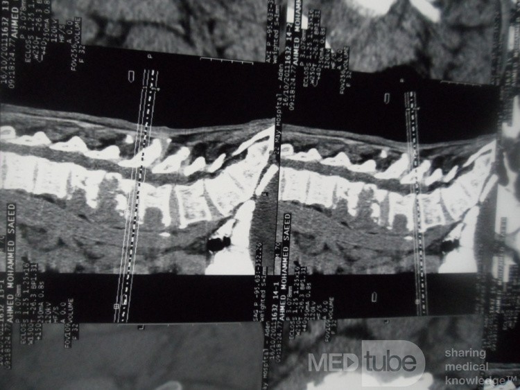 Pancreas cancer - 9