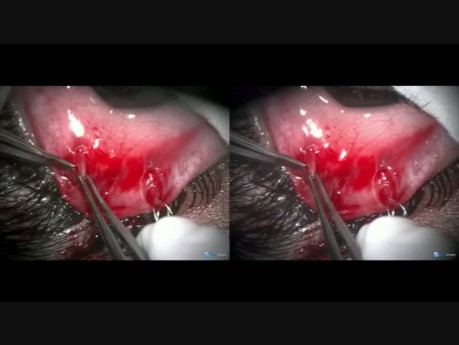 Surgery of Severe Ptosis, Singh Technique