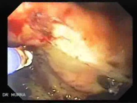 Gastrointestinal Bleeding Caused by Advanced Gastric Carcinoma - Ablation