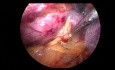 Decorticating the Hilar Renal Cyst by Retroperitoneal Laparoscopic Surgery