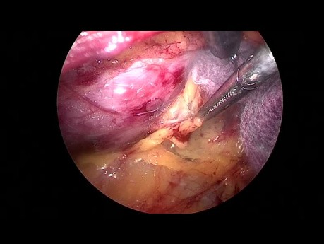 Decorticating the Hilar Renal Cyst by Retroperitoneal Laparoscopic Surgery