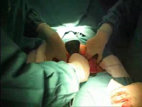 Caesarean Section for Acute Fetal Distress in an Obese Mother, Emergency Case
