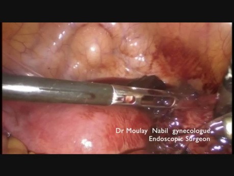 Tips and Trikcs. Conservative Treatment of Ectopic Pregnancy