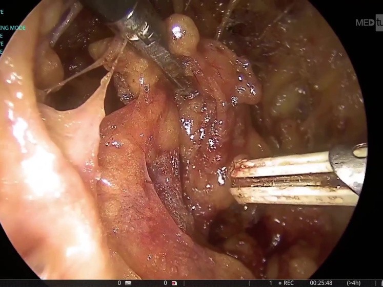Axilloscopic Lymph Node Dissection: техническое руководство по навигации в сложной нейроваскулярной анатомии подмышечной впадины