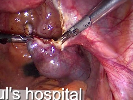 Treatment for Ectopic Pregnancy - Salpingostomy by Use of Laparoscopic Surgery