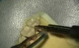 Ultrasonic Endoscopic  Debridement Simulation (UL Palatal)