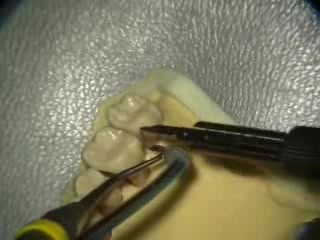 Ultrasonic Endoscopic  Debridement Simulation (UL Palatal)