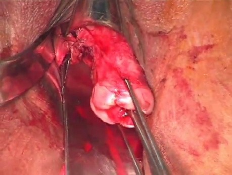 Removal of the Uterus Through the Vagina, Part 1