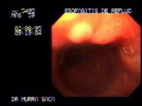 Esophagitis - Severe Case