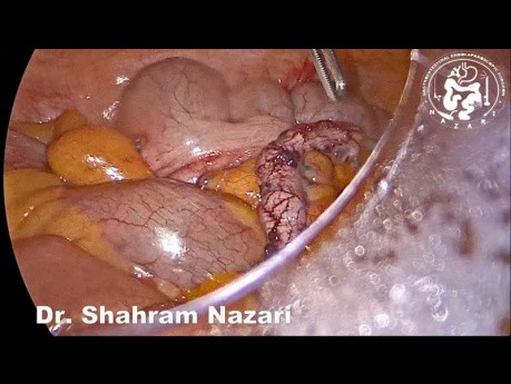 Laparoscopic Appendectomy Technique