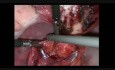 Laparoscopic IUD Extraction from The Rectum