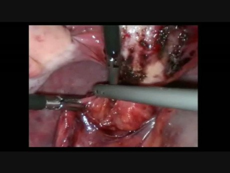 Laparoscopic IUD Extraction from The Rectum