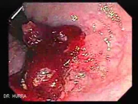 Tubulo - Villous Rectal Adenoma - Endoscopy (8 of 35)