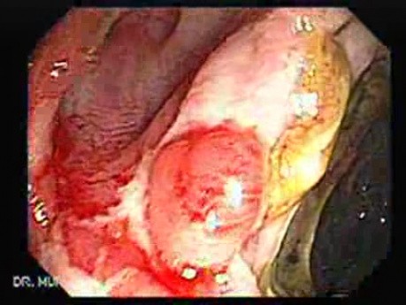 Severe case of Ischemic Colitis (4 of 19)