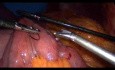 Laparoscopic Gastric Bypass - Part 3