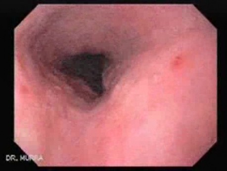 Cytomegalovirus Esophagitis - 42 Years-Old Male