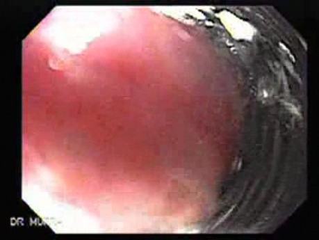 Long Standing Alcohol Abuse - View Through Special Cylinder