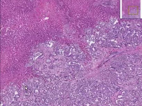 Pancreatic Carcinoma - Histopathology of kidney, liver, heart