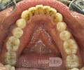Orthodontic Case, What Treatment Plan?