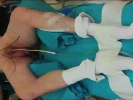 Video-Endoscopic Inguinal Lymphadenectomy