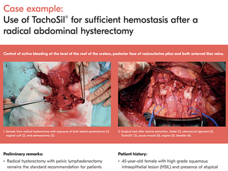 Use of TachoSil® for Sufficient Hemostasis After a Radical Abdominal Hysterectomy