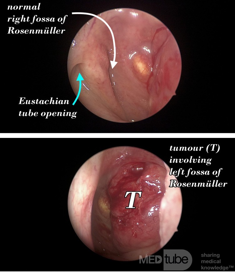 Nasopharyngeal Carcinoma
